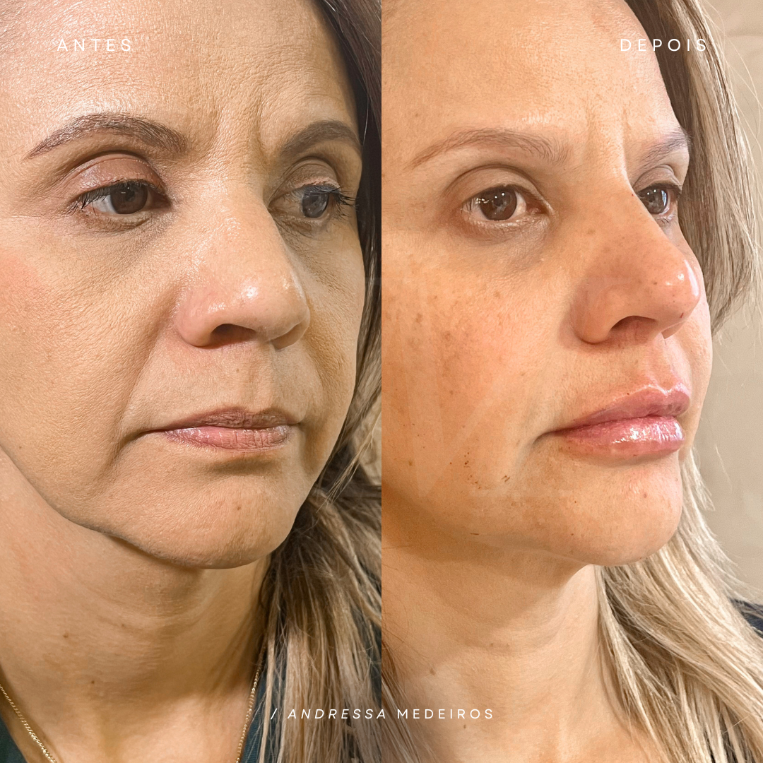 Antes e depois - Full Regenera