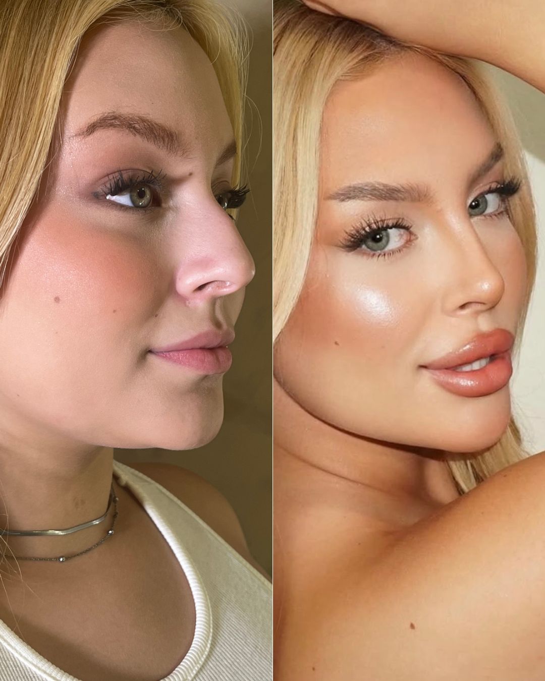 Antes e depois - Método Profile